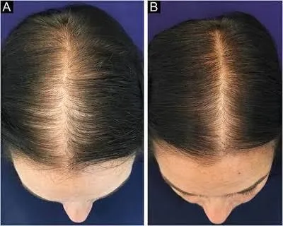 a reference of female pattern hair loss condition