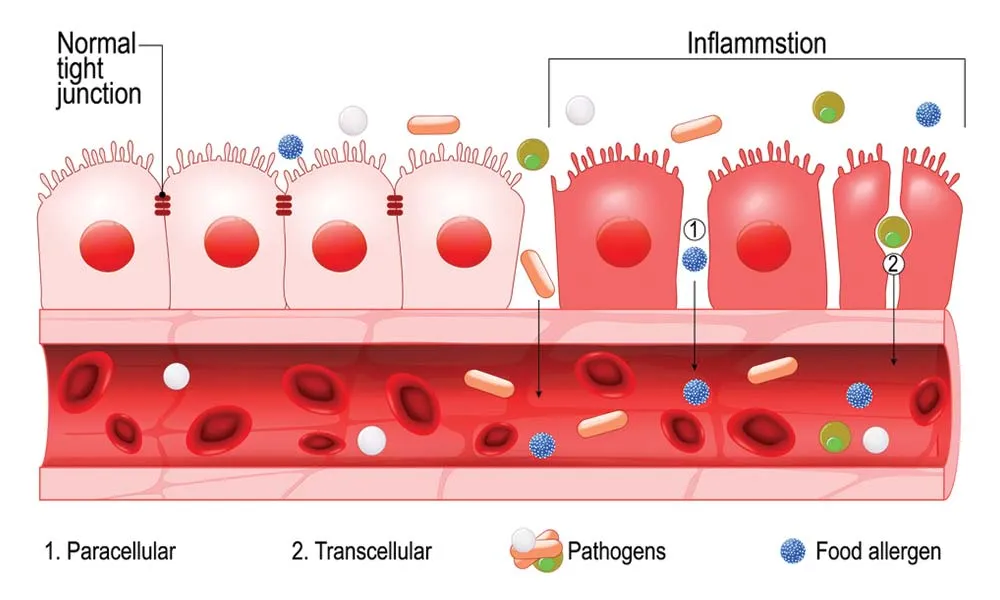leaky gut condition reference image