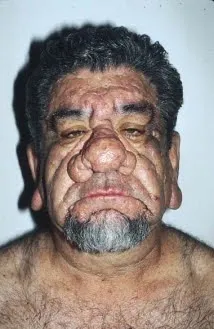 A person with pseudoacromegaly: a coarsening of facial features