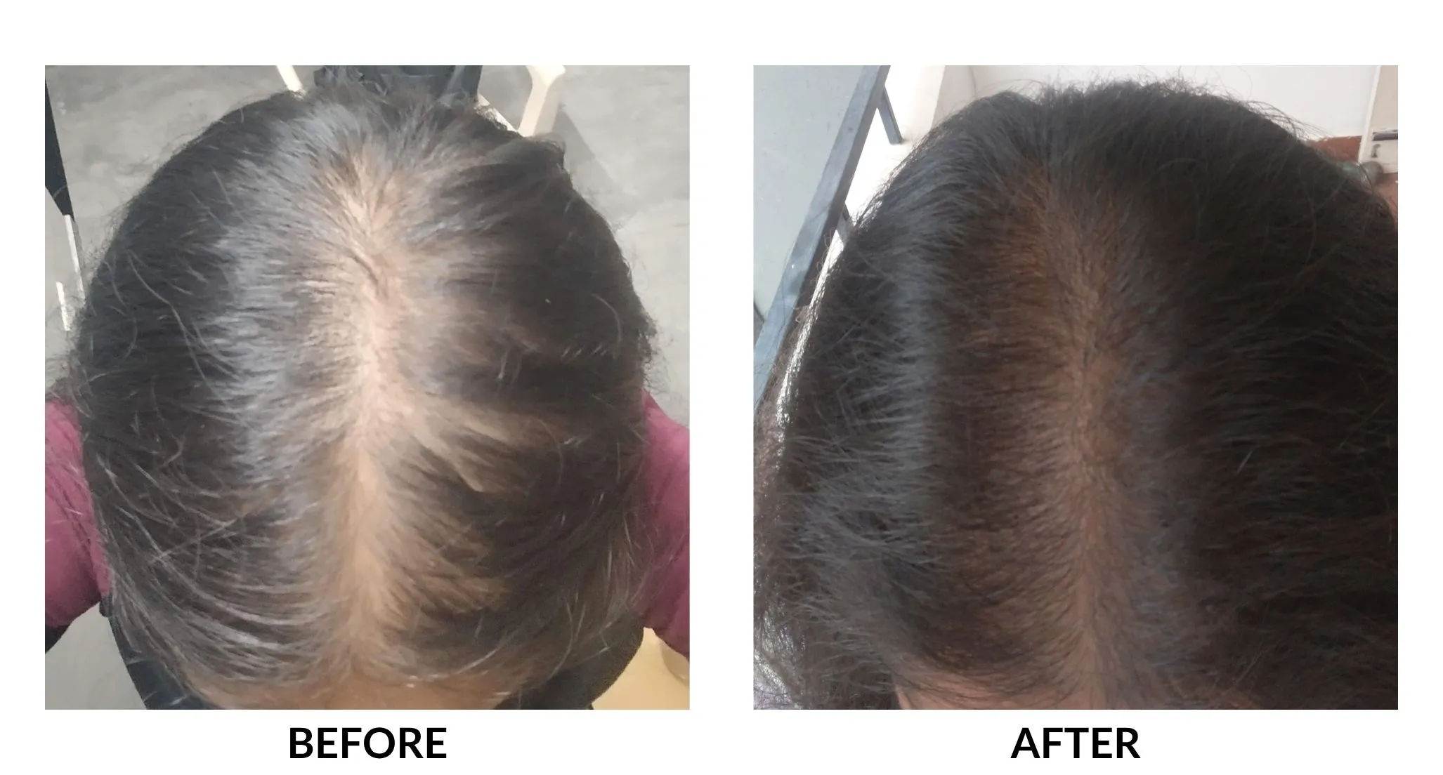 My wife's crown before and after. Scalp visible through a wide part on the left, denser coverage and a narrower part on the right