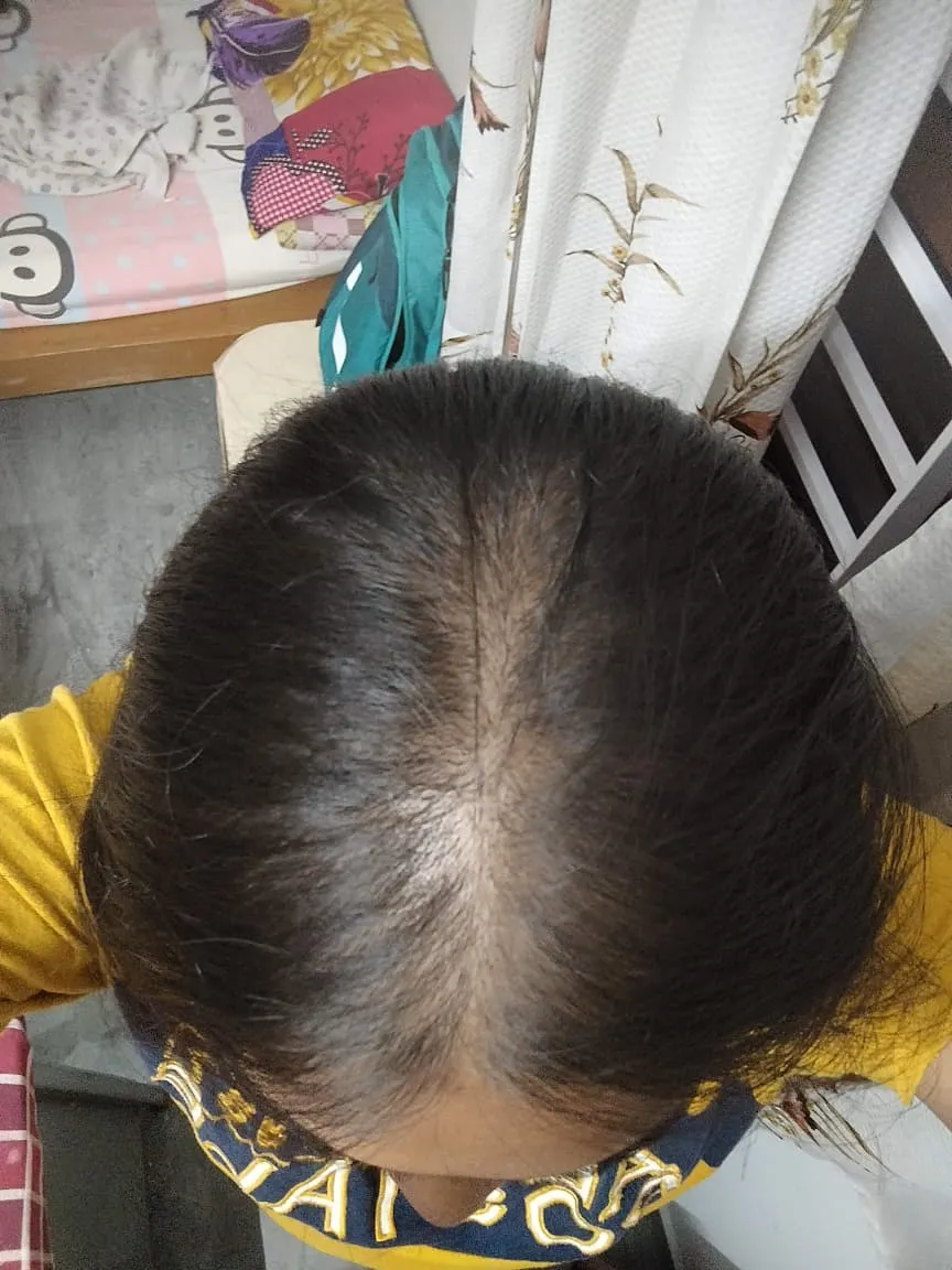 my wife's scalp after GFC therapy