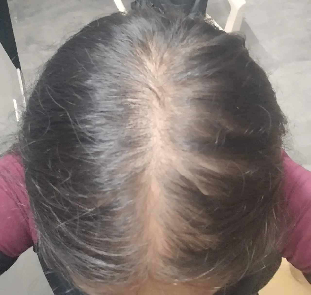 My wife with clearly visible scalp in 2024