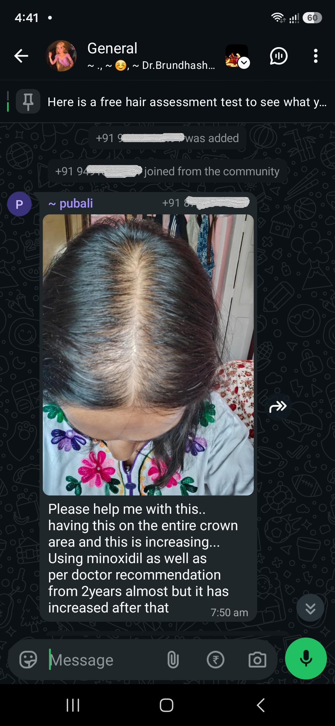 Two years on minoxidil, on her doctor's instruction. She says her crown has got worse since she started.