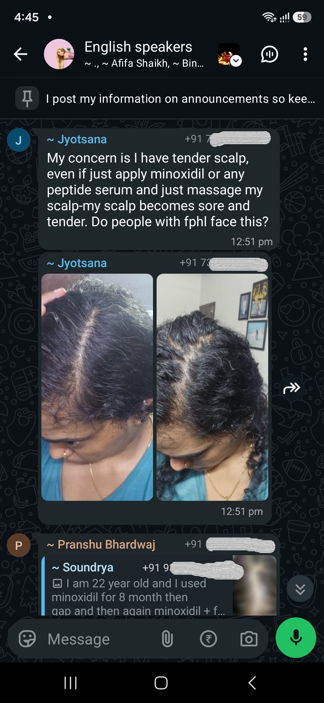 Her scalp turns sore every time she applies minoxidil.