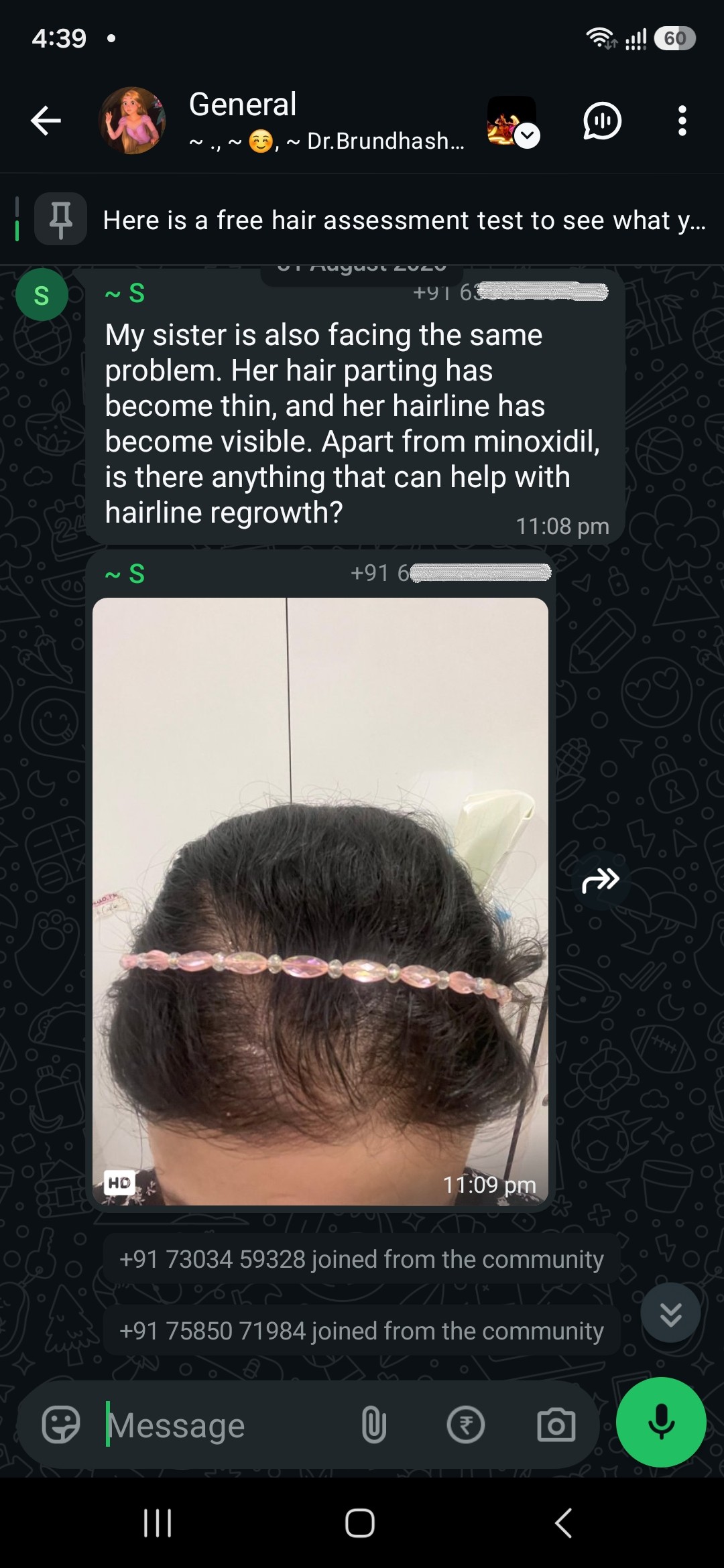 "Apart from minoxidil, is there anything that can help with hairline regrowth?"